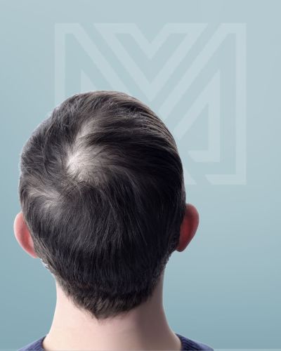 Vieillissement des cheveux : signes, causes et traitements