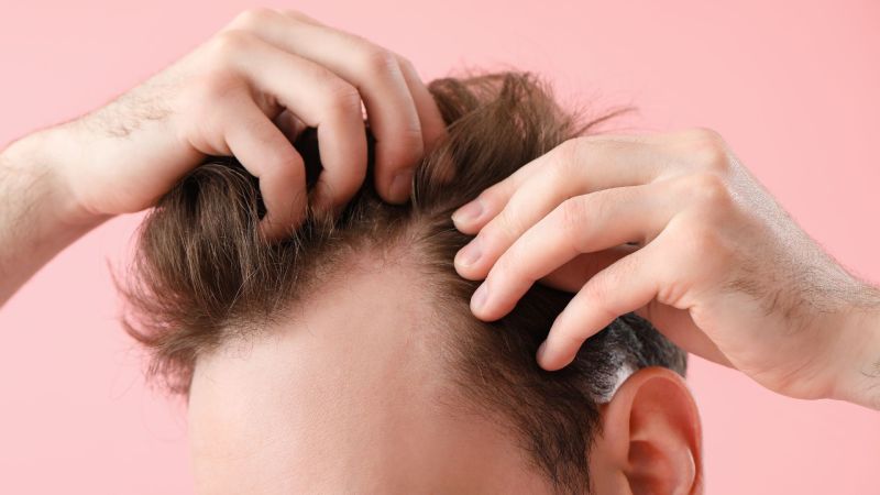 Les secrets pour retrouver une masse capillaire abondante : Conseils d'un expert en greffe de cheveux