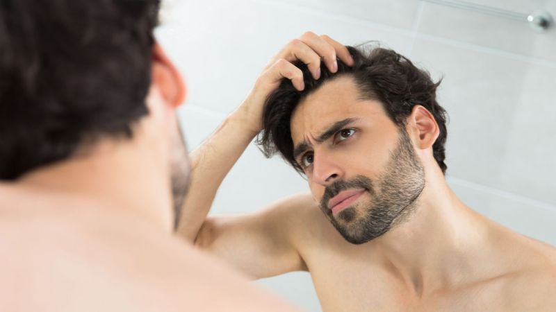 Est-il possible de perdre ses cheveux après une greffe capillaire ?
