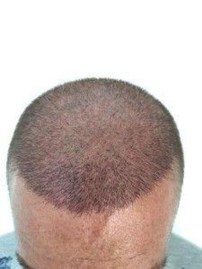 Comment procéder à une greffe de cheveux ? Guide complet pour retrouver une chevelure abondante.
