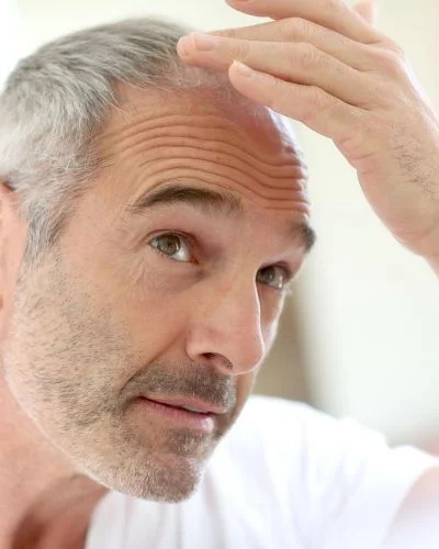 quand faire une greffe de cheveux homme age