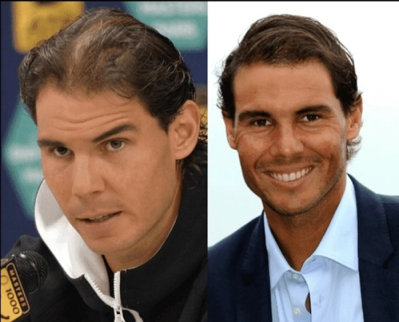 Nadal-greffe-cheveux