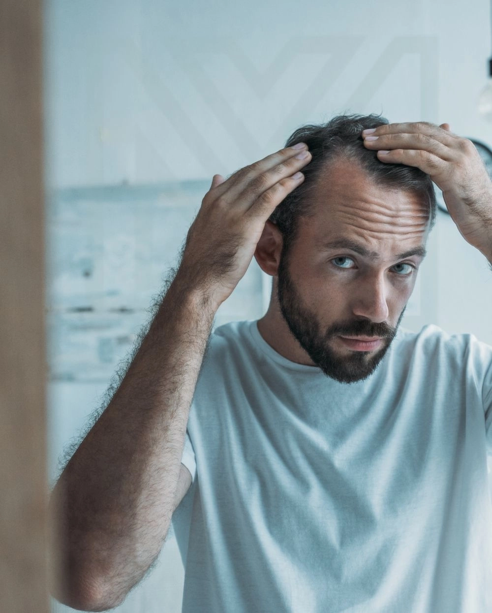 perte-de-cheveux-MBM