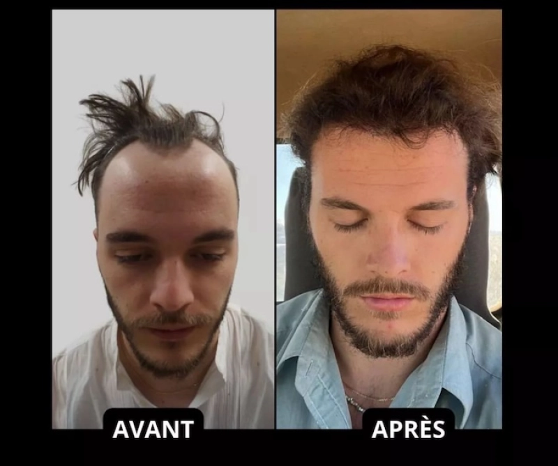 exemple resultats greffe cheveux turquie