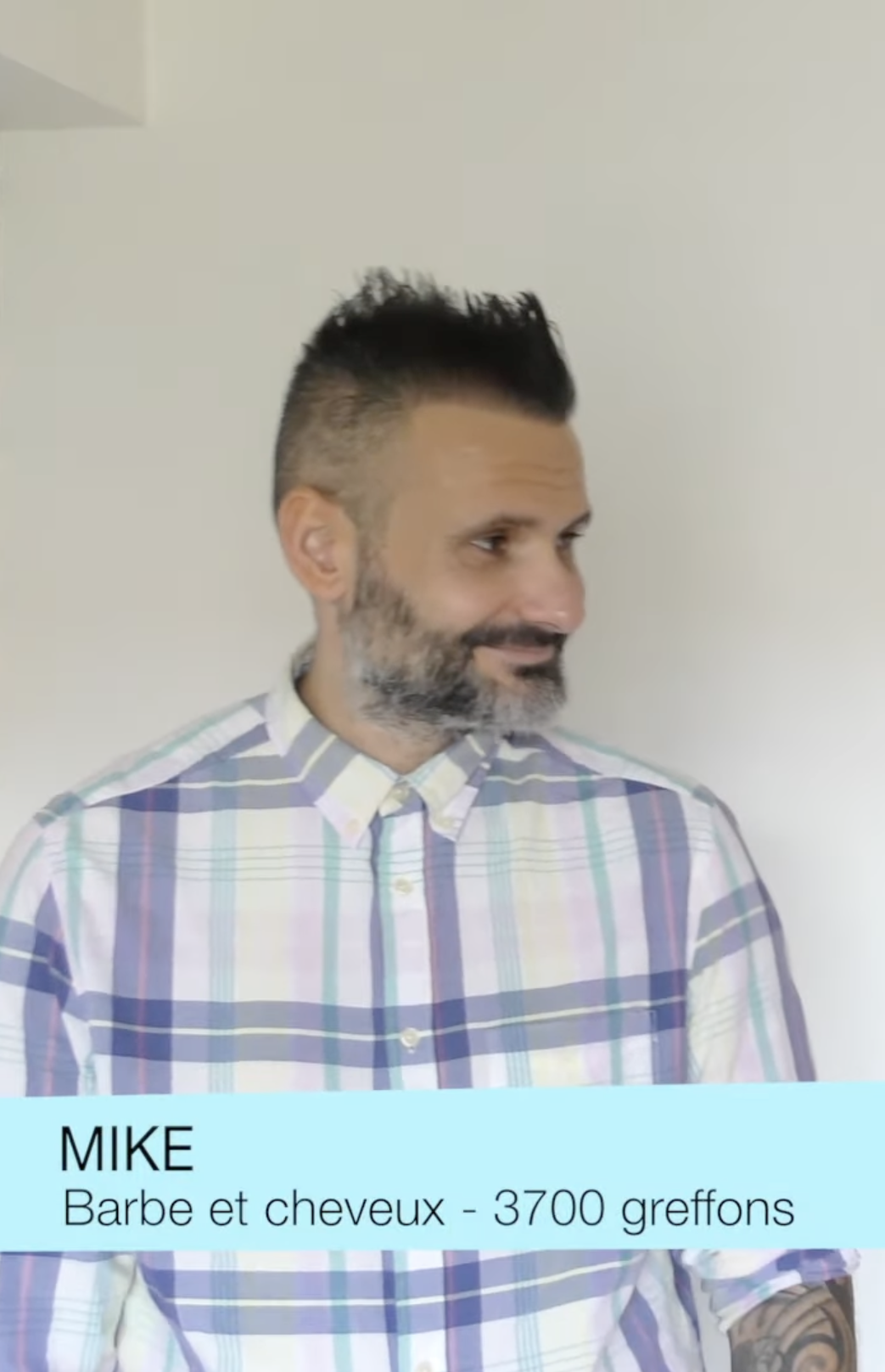 Avant-après de Mike à 10 mois de sa greffe